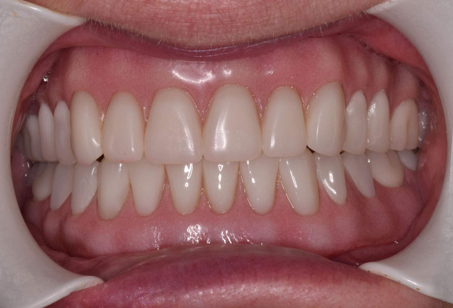 Cosmetic Dentures in Nacogdoches, TX