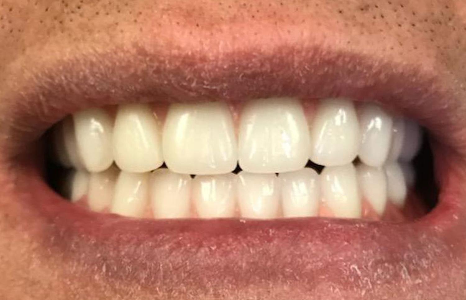 Immediate Dentures in Nacogdoches, TX